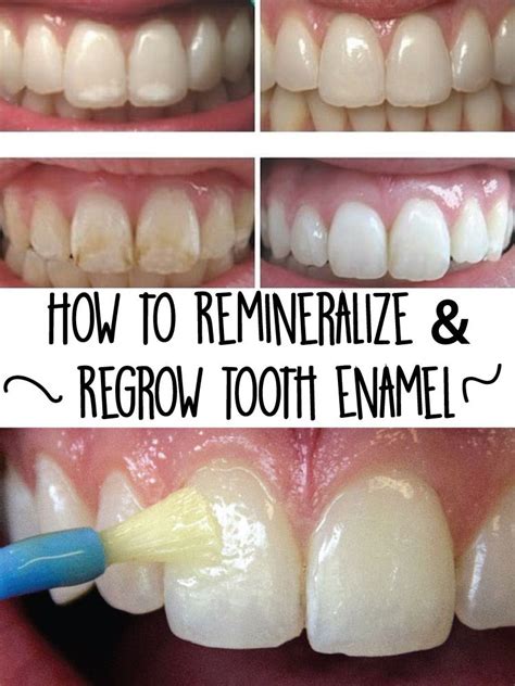 How To Restore Enamel