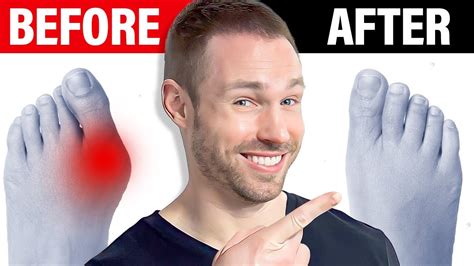 How To Shrink Bunions Naturally