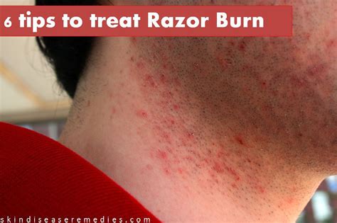 How To Soothe Razor Burn