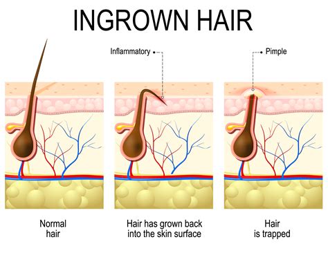 How To Stop Ingrown Hairs
