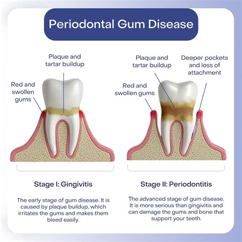 How To Treat Gum Disease