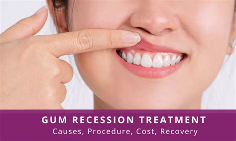 How To Treat Gum Recession