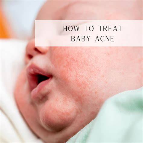 How To Treat Newborn Pimples