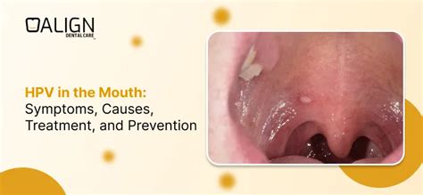 Hpv Inside Mouth Pictures