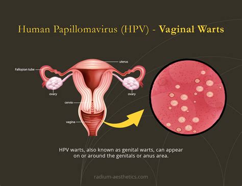 Hpv Virus Symptoms In Women