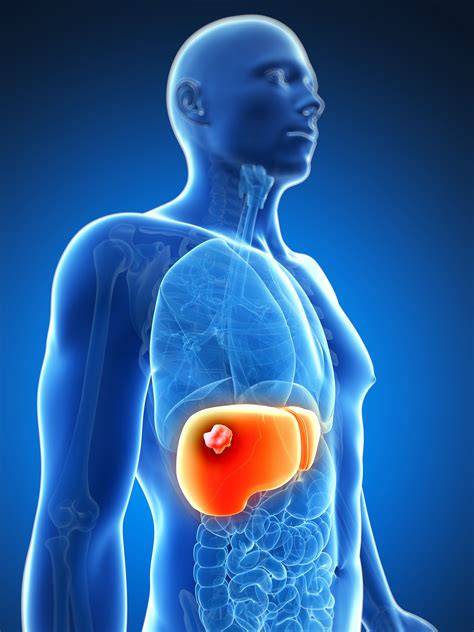 Human Liver Cancer