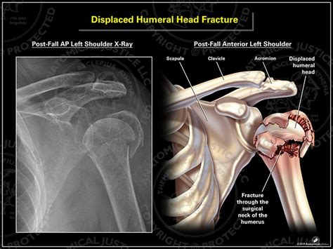 Humeral Head Fracture