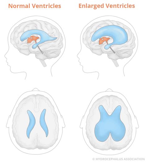 Hydrocephalus In Adults