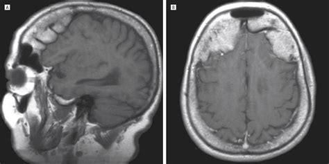 Hyperostosis Frontalis Interna