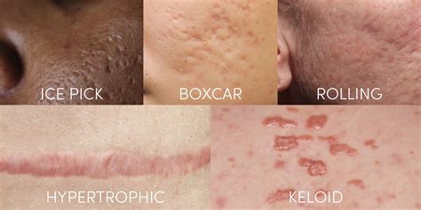 Hypertrophic Acne Scars
