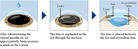 Icl Eye Surgery