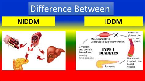 Iddm Medical Abbreviation