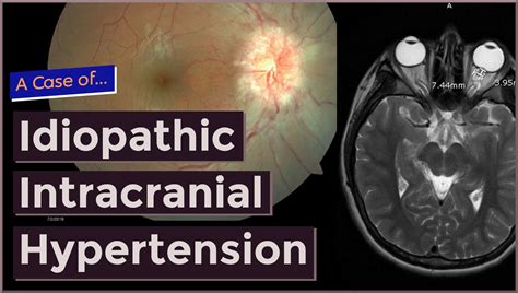 Idiopathic Intracranial Hypertension Specialists