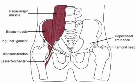 Iliacus Muscle Pain