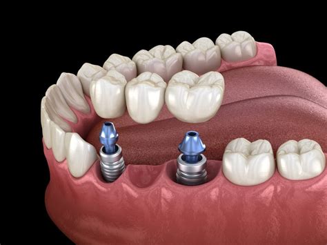 Implant Supported Bridge