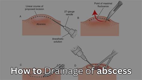 Incision And Drainage Of Abscess