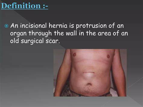 Incisional Hernia Incisional Hernia Photos
