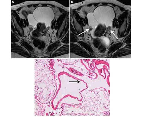 Inclusion Peritoneal Cyst