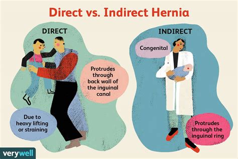 Indirect Hernia Vs Direct