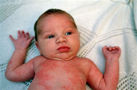 Infant Heat Rash