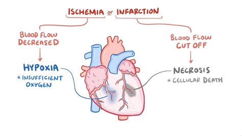 Infarction Vs Ischaemia