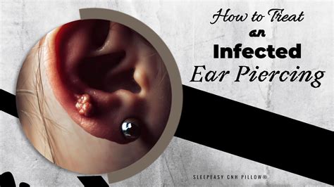 Infected Ear Piercing