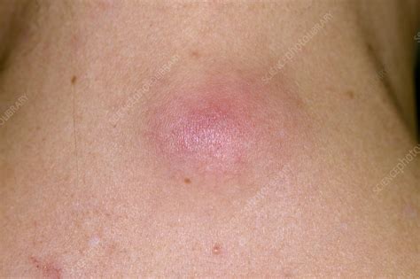 Infected Sebaceous Cyst