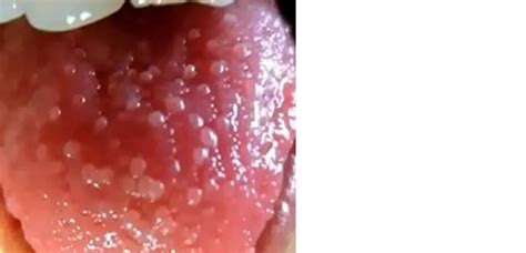 Infected Taste Bud On Tongue
