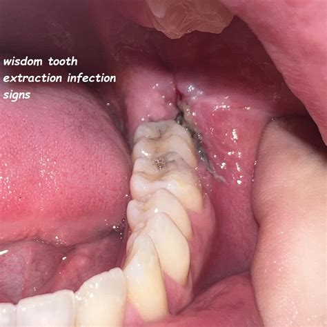 Infected Wisdom Tooth Extraction