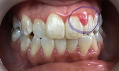 Inflamed Gum Around Tooth