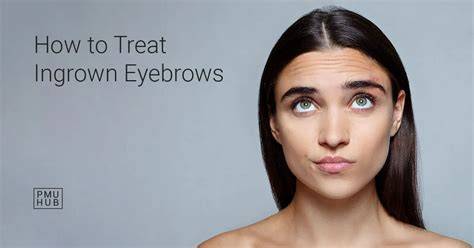 Ingrown Eyebrow Hair