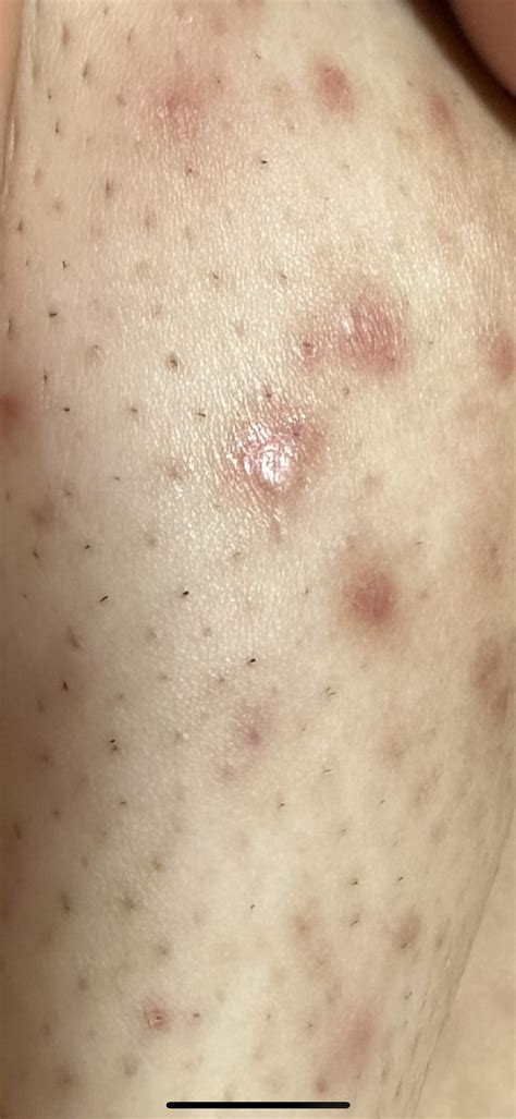 Ingrown Hair Scars