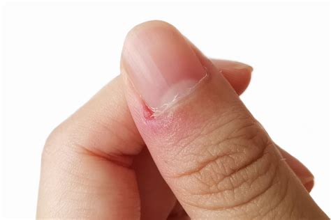 Ingrown Thumb Nail