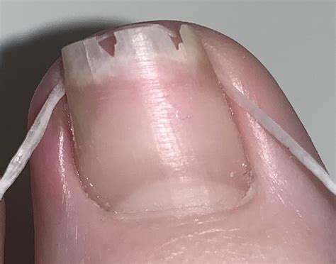 Ingrown Toenail Floss