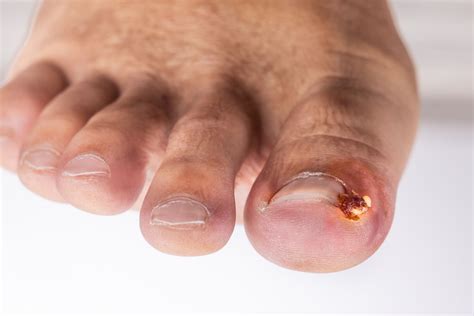 Ingrown Toenail Infection
