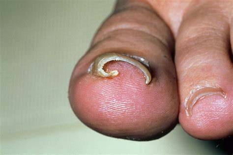 Ingrown Toenail Pus