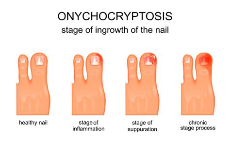 Ingrown Toenail Symptoms
