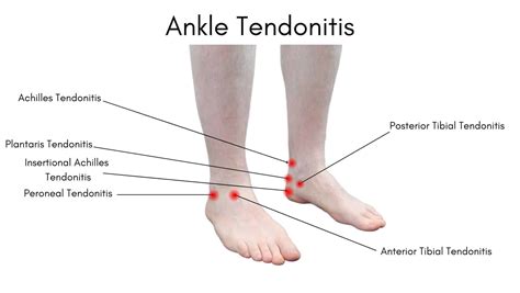 Inner Ankle Pain
