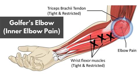 Inner Elbow Pain
