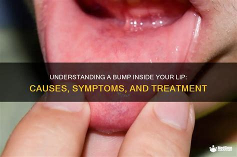 Inside Lip Bump Clear