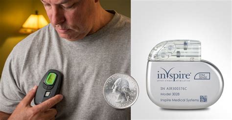 Inspire Sleep Device
