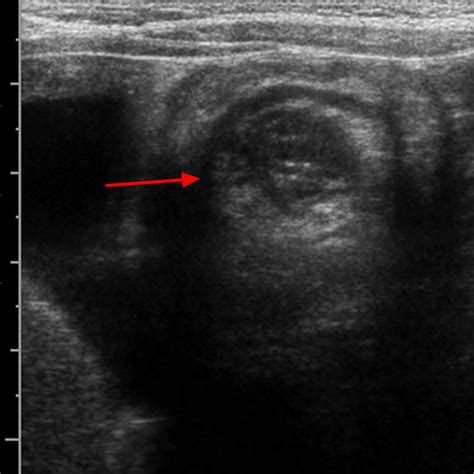 Intussusception On Ultrasound