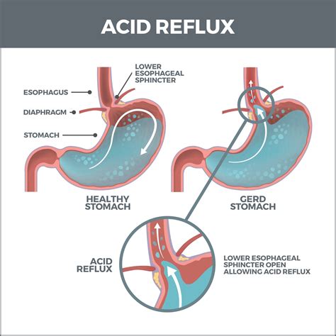 Is Acid Reflux Disease Hereditary
