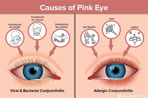 Is Bacterial Pink Eye Contagious