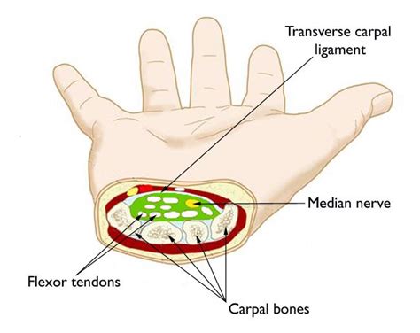Is Carpal Tunnel Genetic
