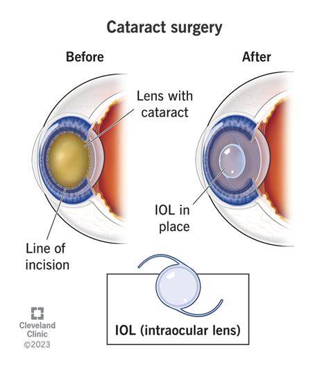 Is Cataract Surgery Painful