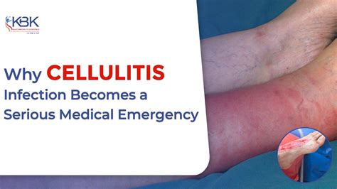 Is Cellulitis Spreadable