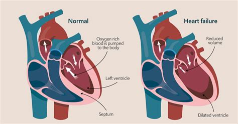 Is Congestive Heart Failure Reversible