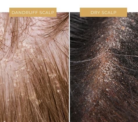 Is Dandruff Communicable