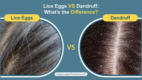 Is Dandruff Spreadable